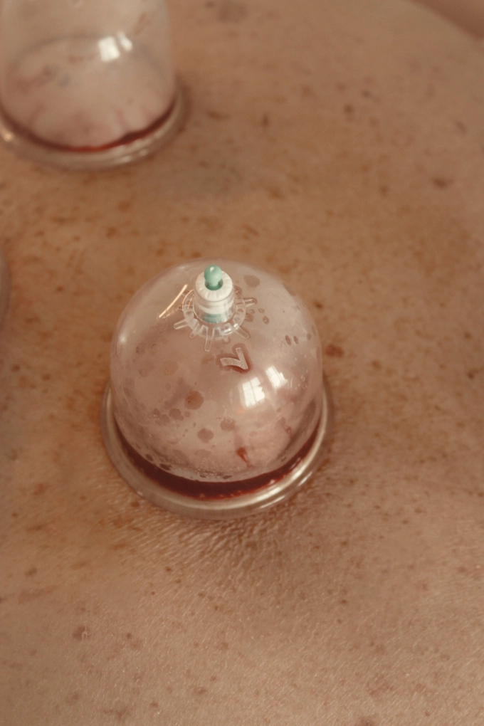 Hijama Cupping