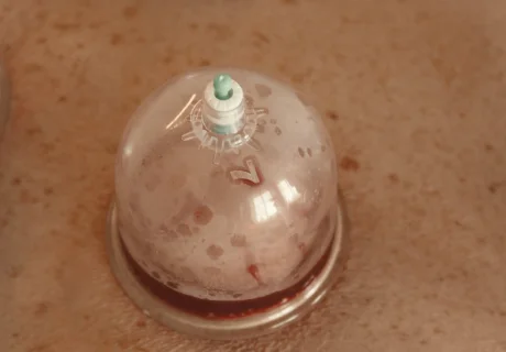 Hijama Cupping