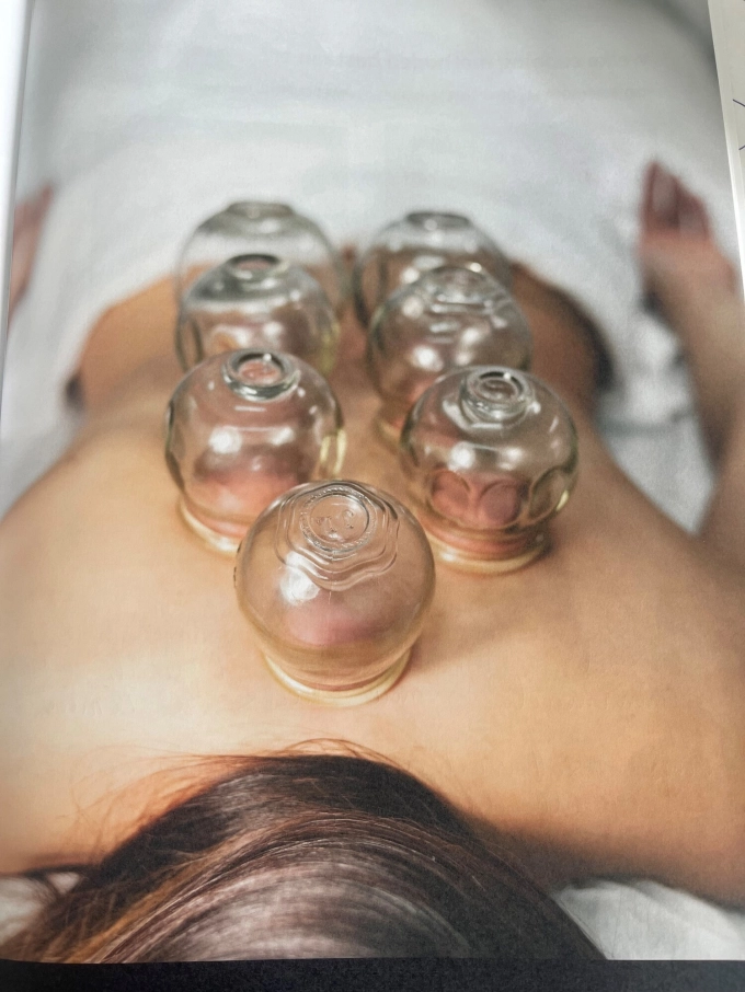 Vuurcupping