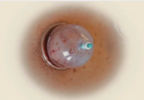 Wet Cupping