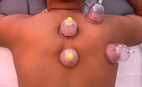 Hijama Cupping